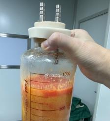金湖水动力吸脂手术要做多久？
